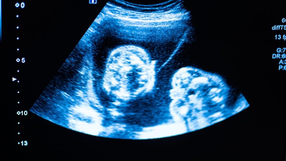 Detailed Fetal Ultrasound Scan On A Monitor - DR Vinayak das Blog